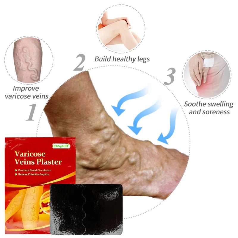 6 Piezas = 1 Bolsa, Tratamiento para Várices, Medicina Herbal China, Eliminación de Angiitis, Flebitis, Venas Araña, Parche para el Dolor de Venas