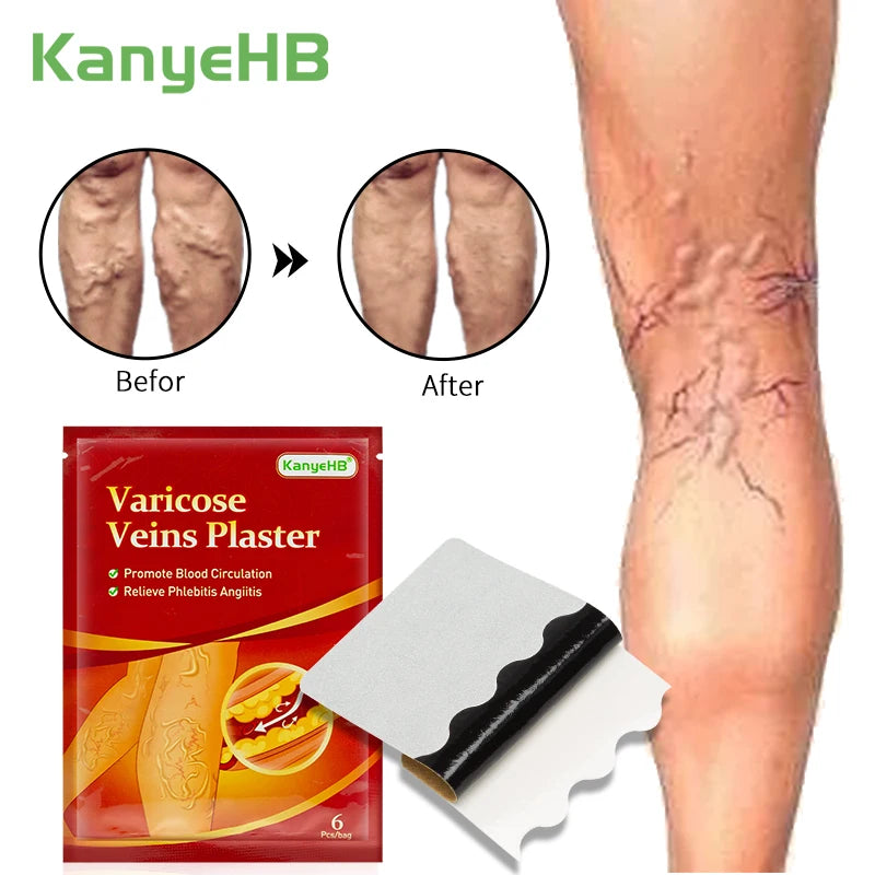 6 Piezas = 1 Bolsa, Tratamiento para Várices, Medicina Herbal China, Eliminación de Angiitis, Flebitis, Venas Araña, Parche para el Dolor de Venas