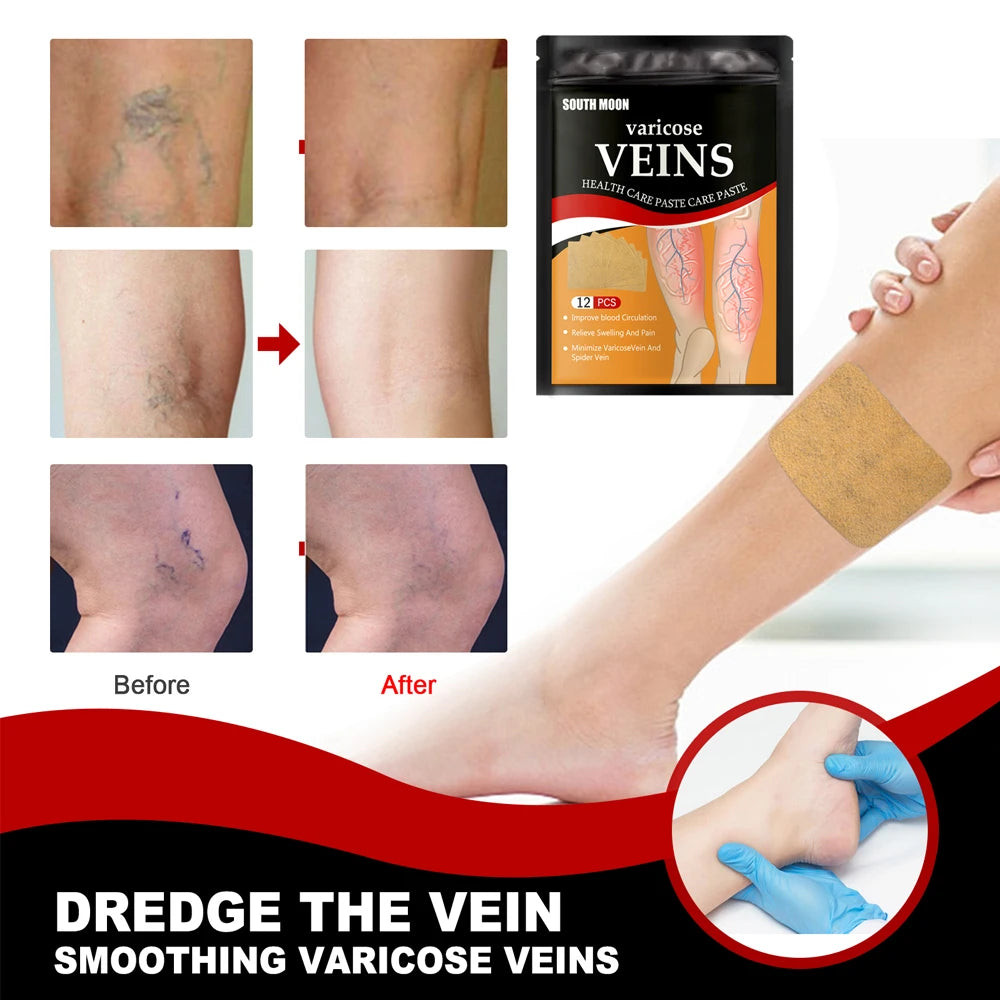 Parche para tratamiento de venas varicosas, yeso para hinchazón dolor de piernas, promueve el metabolismo, promueve la circulación sanguínea suave, Unisex, 12/24 unidades