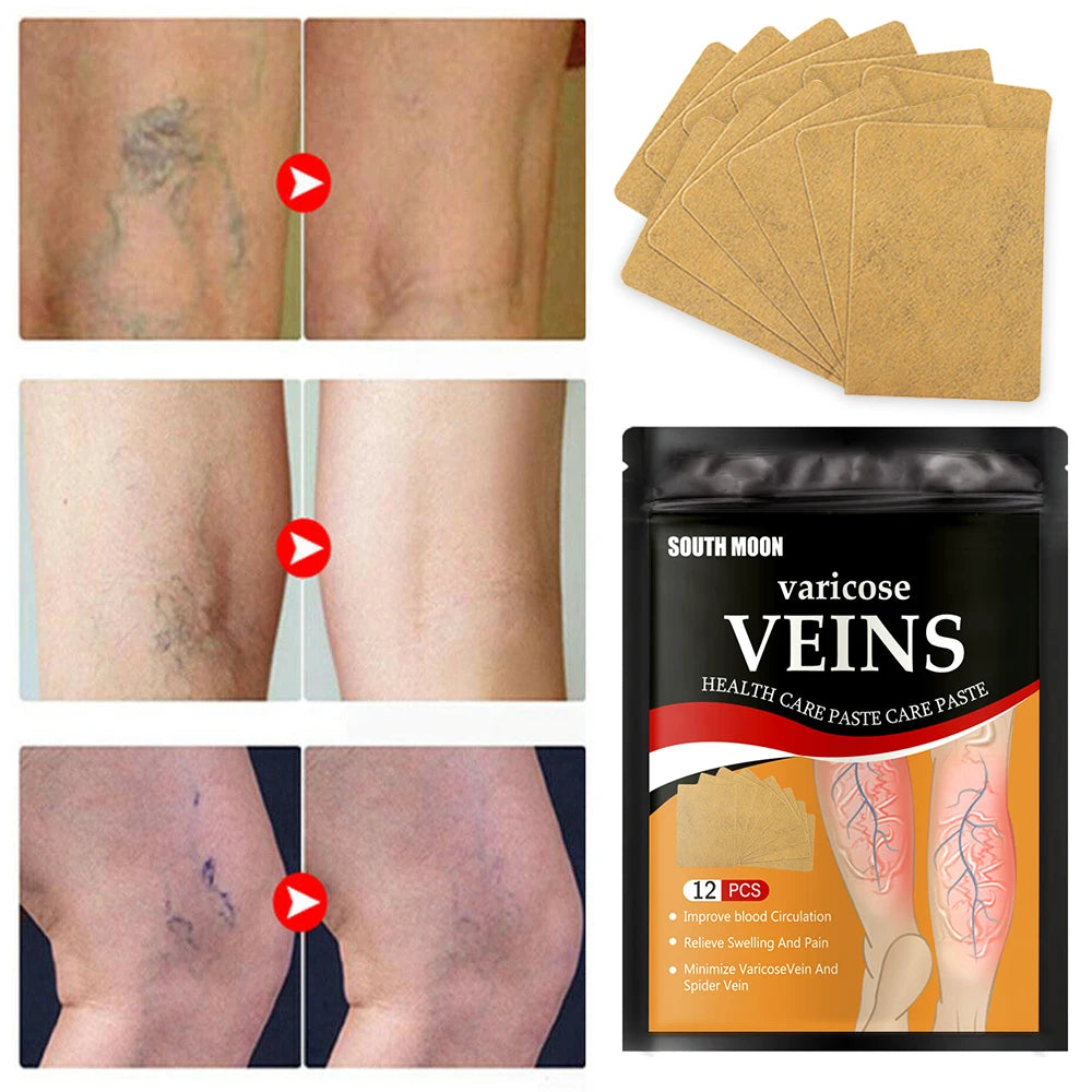 Parche para tratamiento de venas varicosas, yeso para hinchazón dolor de piernas, promueve el metabolismo, promueve la circulación sanguínea suave, Unisex, 12/24 unidades
